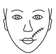 scar treatment - Juvan MD- Fotona laser